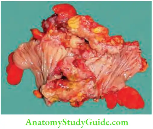 Intestinal Obstruction Sigmoid Stricture Due To Carcinoma