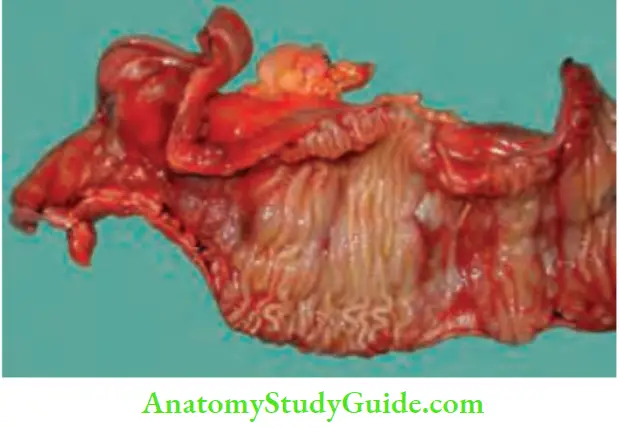 Intestinal Obstruction Tubercular Stricture Annular Stricture