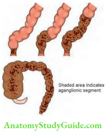 Intestinal Obstruction Types Of Hirschsprungs Disease