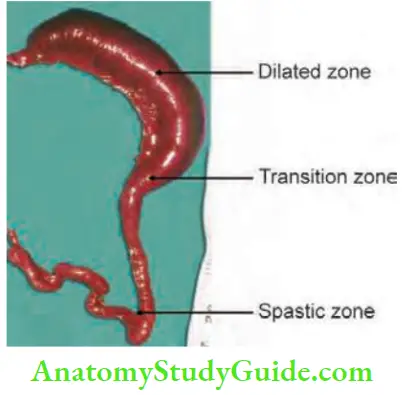 Intestinal Obstruction Vrios Segments Of Teh Large Intestine In Hirschsprungs Disease