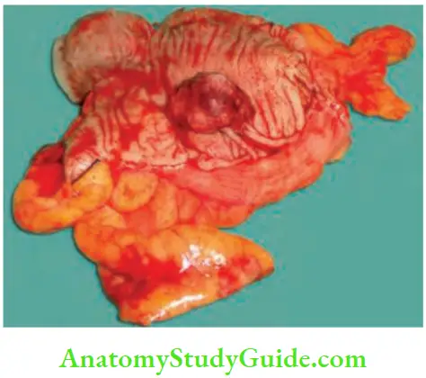 Large Intestine Carcinoma In Polyp