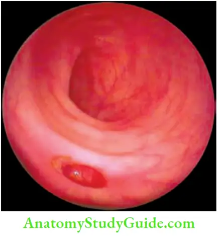 Large Intestine Colonoscopy Showing Opening of Diverticula