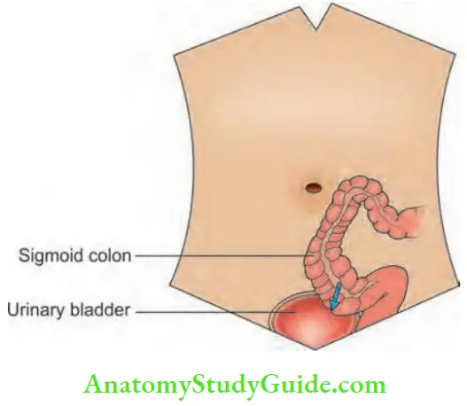 Large Intestine Colovesical Fistula