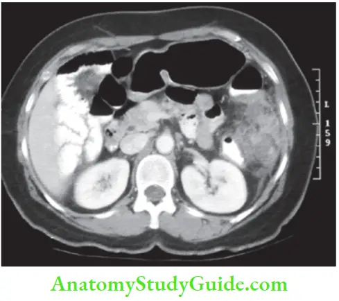 Large Intestine Ct Scan Showing Pericolic Abscess On The Left Paracolic Space