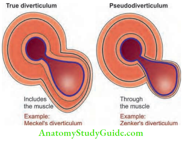 Large Intestine Diverticulum