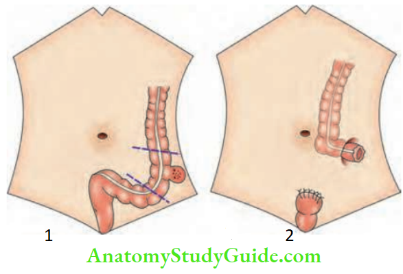Large Intestine Hartmanns Procedure