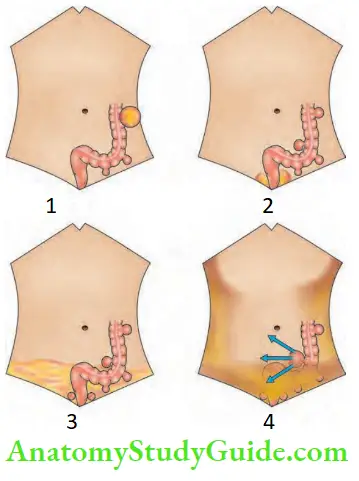 Large Intestine Hinchey Classification