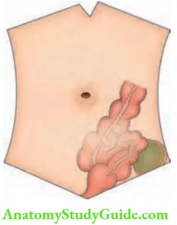 Large Intestine Pericolic Abscess