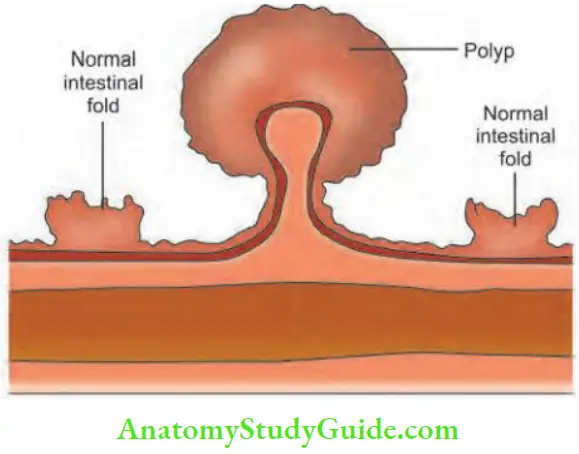 Large Intestine Polyp