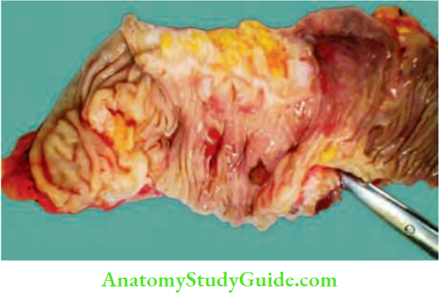 Large Intestine Preforated Diverticula Surgery
