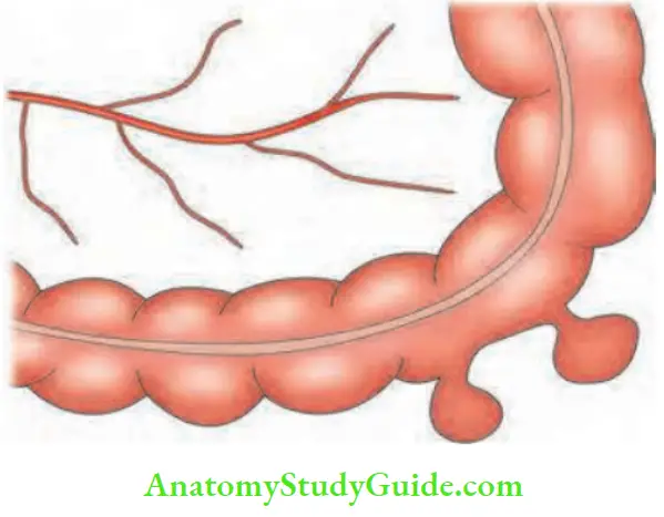 Large Intestine Sigmoid Diverticulae