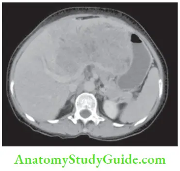 Liver CT scan showing a large hepatoma displacing the portal vein branches