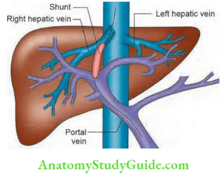 Pyogenic Liver Abscess Portal Hypertension of liver Notes - Anatomy ...