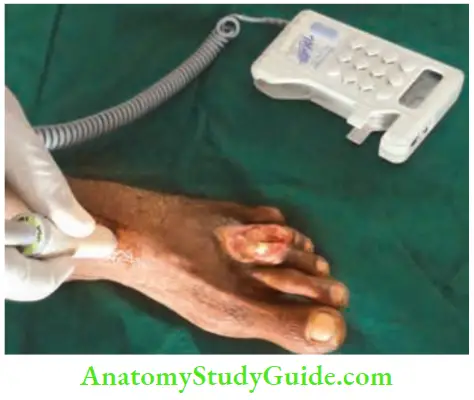 Lower Limb Ischaemia And Popliteal Aneurysm Handheld Doppler Checking The Dorsalis Pedis Artery