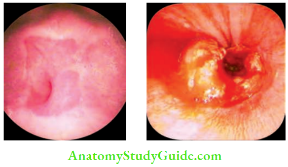 Oesophagus And Diaphragm Barett's Oesophagus With Stricture And Carcinoma GE Junction In Barrett's Oesophagus