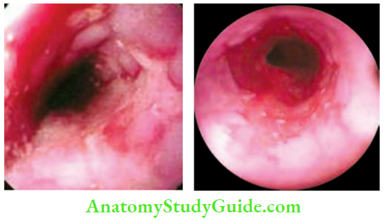 Oesophagus And Diaphragm Endoscopic View Of Reflux Oesophogitts And Batter's Oesophagus