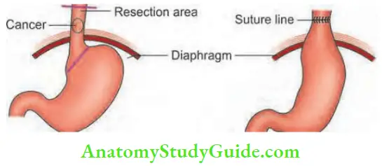 Oesophagus And Diaphragm Ivor Lewis Operation And Anastomosis In The Tharax