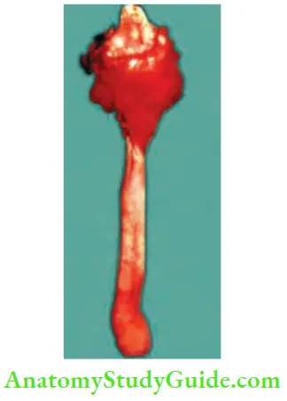 Oesophagus And Diaphragm Total Pharyngalaryngo-oesophagectomy