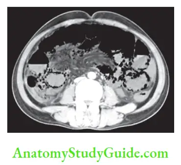 Peritoneum Peritoneal Cavity Mesentery And Retroperitoneum CT showing air in the bowel wall case of superior mesenteric ischaemia