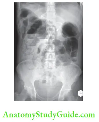 Peritoneum Peritoneal Cavity Mesentery And Retroperitoneum Gas in the bowel wall (pneumatosis) indicates gangrene of the bowel