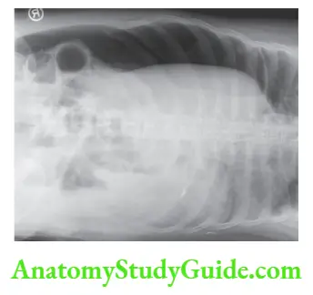 Peritoneum Peritoneal Cavity Mesentery And Retroperitoneum Lateral decubitus X-ray showing free gas in the peritoneal cavity