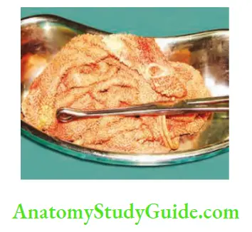 Peritoneum Peritoneal Cavity Mesentery And Retroperitoneum Postoperative peritonitis due to a map left behind following caesarean section