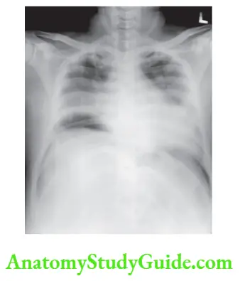 Peritoneum Peritoneal Cavity Mesentery And Retroperitoneum Subphrenic abscess mild pleural effusion on both sides