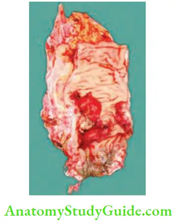 Rectum And Anal Canal Annular Constricting Lesion