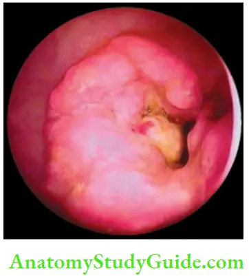 Rectum And Anal Canal Fibreoptic Sigmoidoscopy Of Signet Ring Carcinoma