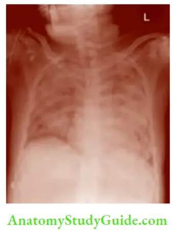 Shock And Haemorrhage Chest X Ray