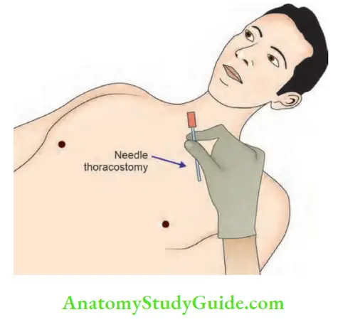 Shock And Haemorrhage Needle Thoracocentesis