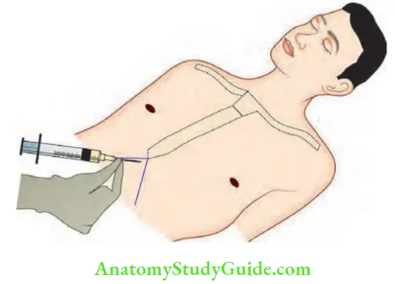 Shock And Haemorrhage Pericardiocentesis