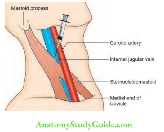 Shock And Haemorrhage Right Internal Jugular Vein Cannulation