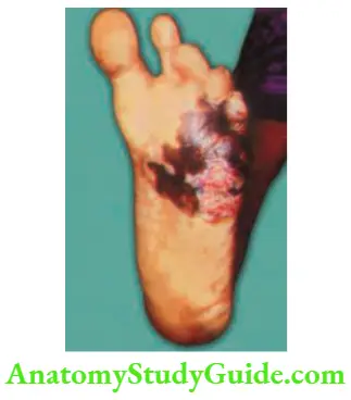 Skin Tumours 8 cm Ulcerated Pigmented Lesion In The Foot Malignant Melanoma Foot Required Amputation