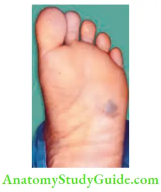 Skin Tumours Acral Lentiginous Variety With Early Changes Never In Cise Or Cauterise Such Melanomas