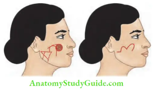 Skin Tumours BCC Excision And Reconstruction By Using Bilobed Flap