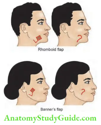 Skin Tumours BCC Reconstruction