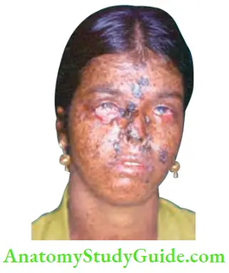 Skin Tumours Basal Cell Carcinoma Involving Nasolabial Fold Skin