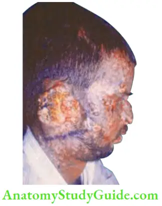 Skin Tumours Basal Cell Carcinoma Involving The Right Ear