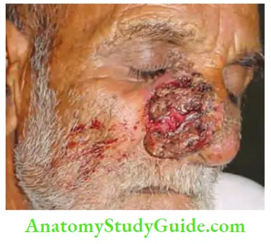 Skin Tumours Basal Cell Carcinoma Typical Site