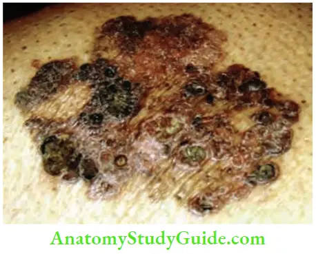 Skin Tumours Bowens Disease Premalignant