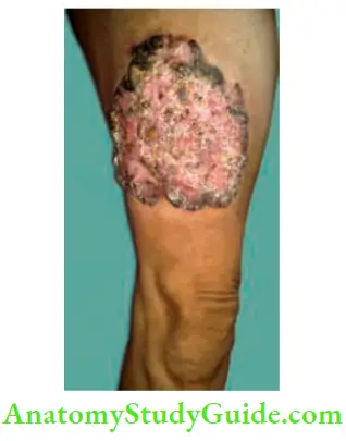 Skin Tumours Bowens Disease With Squamous Cell Carcinoma
