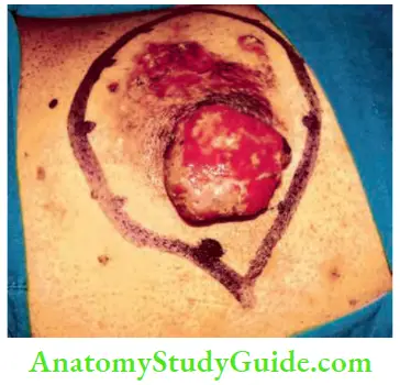 Skin Tumours Bowens Disease With Ulcerated Squamous Cell Carcinoma
