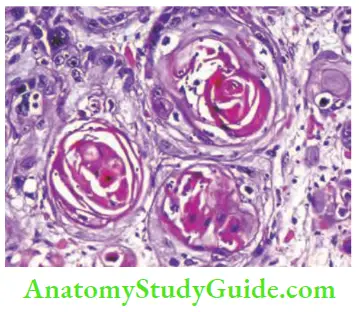Skin Tumours Classical Keratin Pearls Well Differentiated Squamous Cell Carcinoma