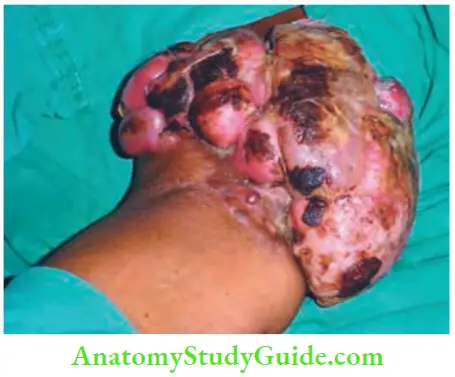 Skin Tumours Dermatofibroma Protuberans Upper Limb