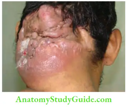 Skin Tumours Dermatofibrosarcoma Over The Nape Of The Neck
