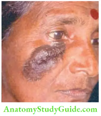 Skin Tumours Dysplastic Naevi Over The Face