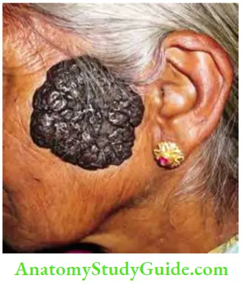 Skin Tumours Dysplastic Naevus Left Parotid Region