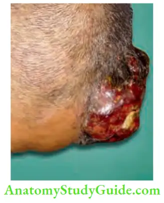 Skin Tumours Epithelioma Scalp large Ulcerating Bleeding Lesion
