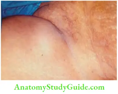 Skin Tumours Hugely Enlarged Inguinal Lymph Nodes The Nodes Can Be Firm To Hard.